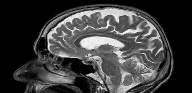 الإصابات الخفيفة في الدماغ الخفيفة سبب للتدهور المعرفي المبكر