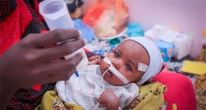 تحذيرات من تعرض ملايين الأطفال في اليمن لسوء التغذية